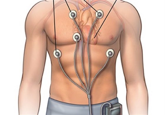 Holter monitorizasiyası Holter monitorizasiyası