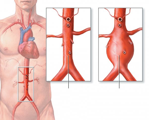 Aorta xəstəliklərində müdaxilələr
