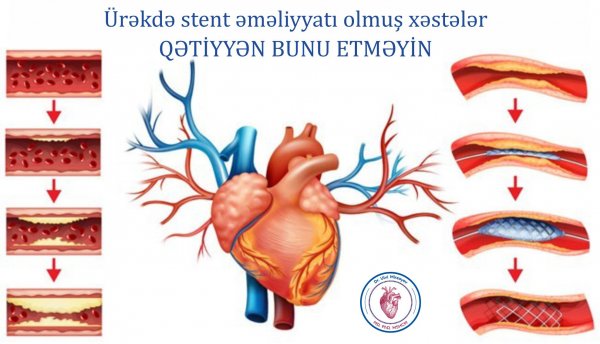 Ürəkdə stent əməliyyatı olmuş xəstələr qətiyyən bunu etməyin Ürəkdə stent əməliyyatı olmuş xəstələr qətiyyən bunu etməyin