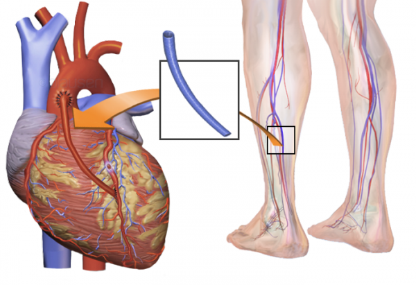 Hansı ürək əməliyyatı?, Stent yoxsa arterial koronar şuntlama? Hansı ürək əməliyyatı?, Stent yoxsa arterial koronar şuntlama?